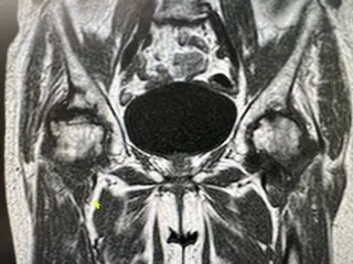 MRI Before Treatment
