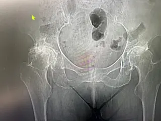 X-Ray Before Treatment