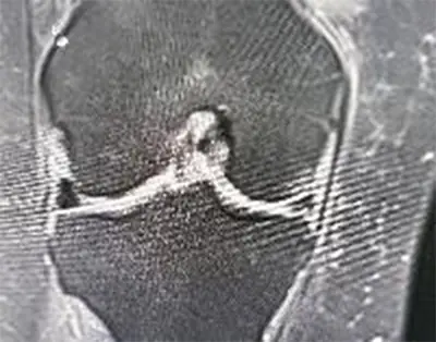 After Treatment